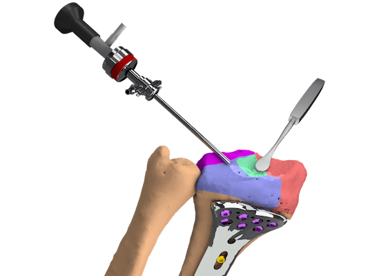 arthroscopie du poignet