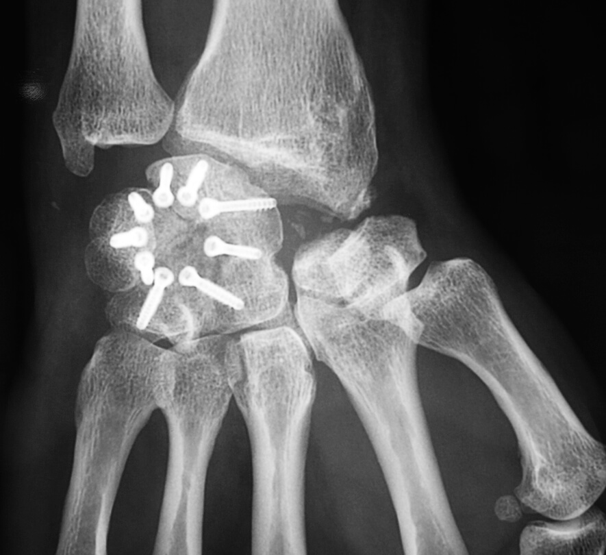 Arthrodèse partielle du carpe (cupule vissée radiotransparente)