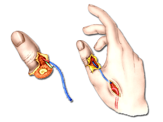 Amputation du pouce amputation digitale