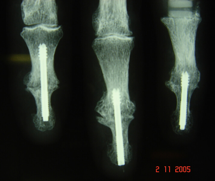 Arthrodèse IPD par vis enfouie