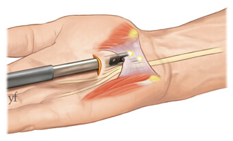 chirurgie du syndrome du canal carpien