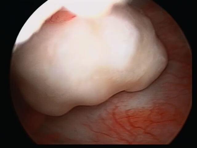 chondromatose du coude