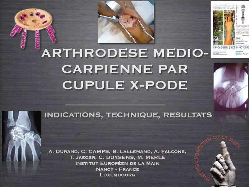 arthrodèse médiocarpienne par cupule XPode