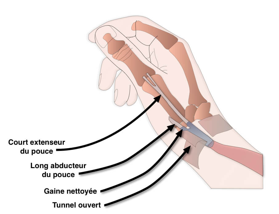 traitement chirurgical de la ténosynovite de de Quervain