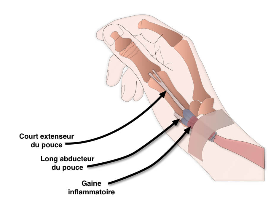schéma de la ténosynovite de de Quervain