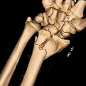 Fracture du poignet