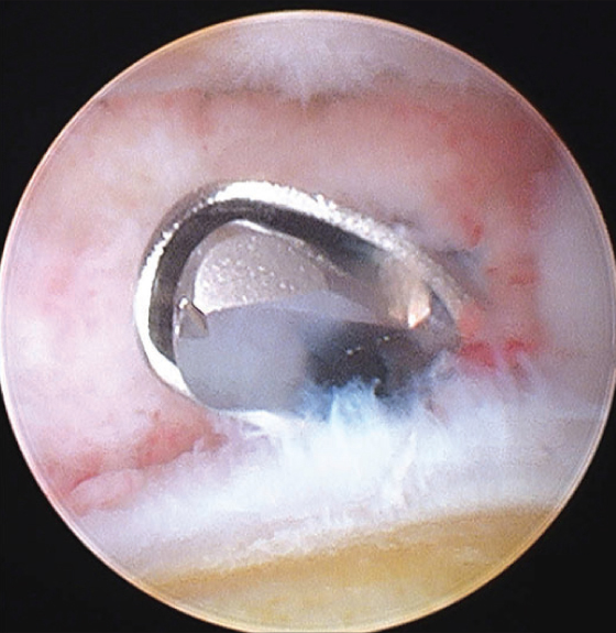 Vue arthroscopique de l'articulation trapézo-métacarpienne