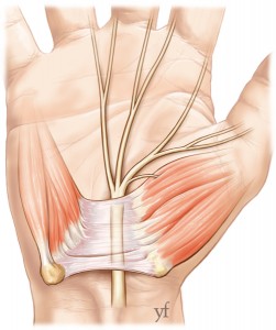 chirurgie du nerf médian au canal carpien