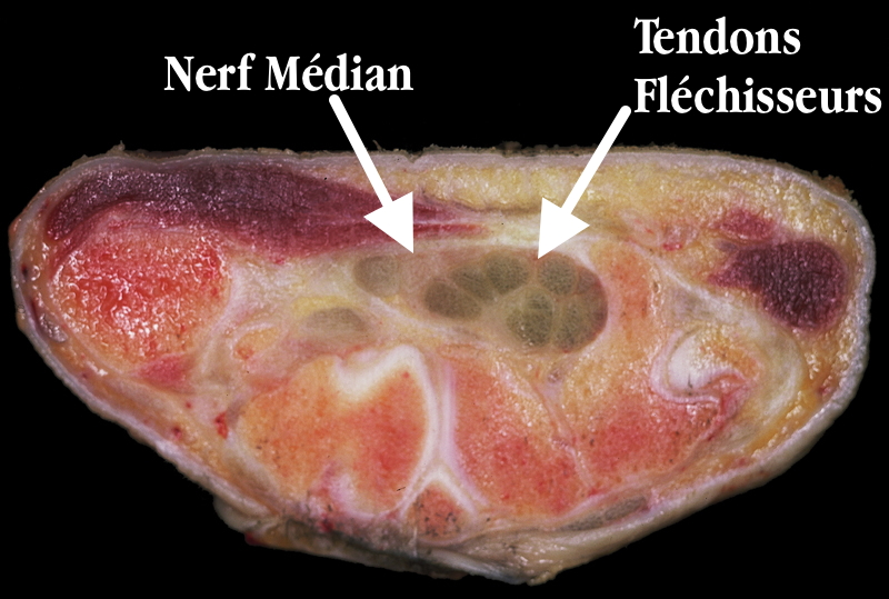 coupe anatomique du canal carpien