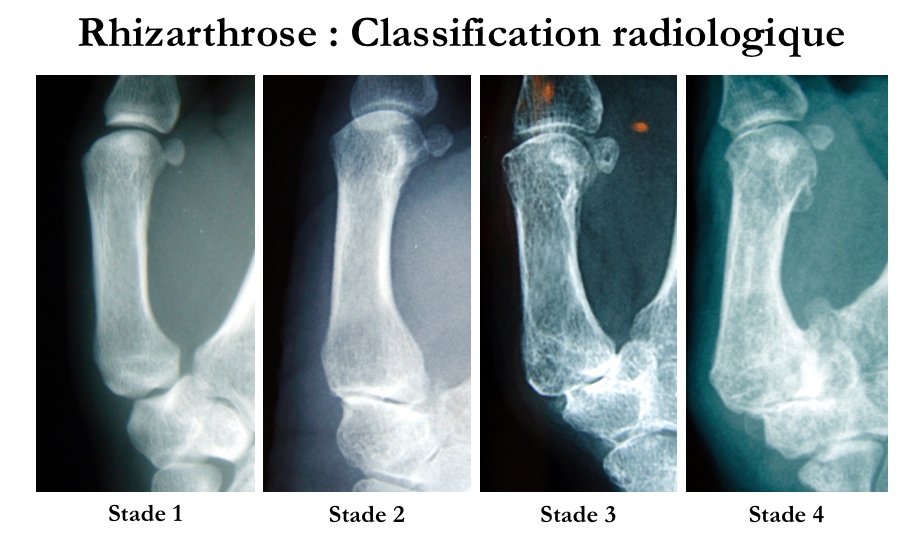 Classification radiologique de la rhizarthrose