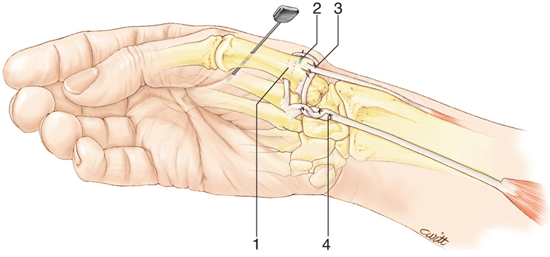 Ligamentoplastie d'Eaton-Littler