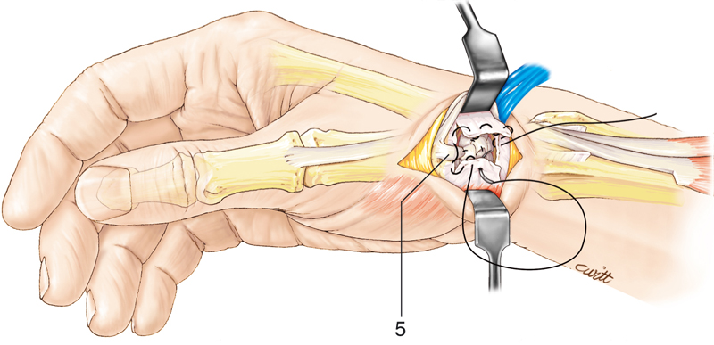 Trapézectomie - tendinoplastie d'interposition