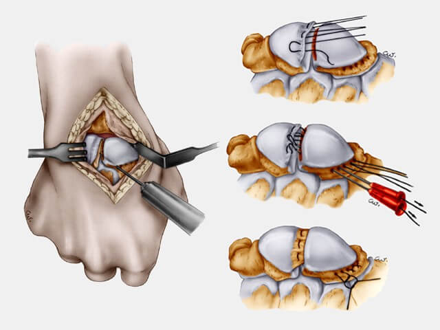 réparation du ligament scapholunaire