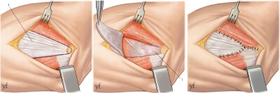 ténotomie d'allongement des épicondyliens