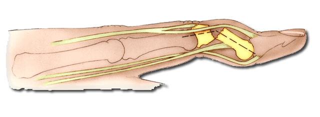 fracture digitale