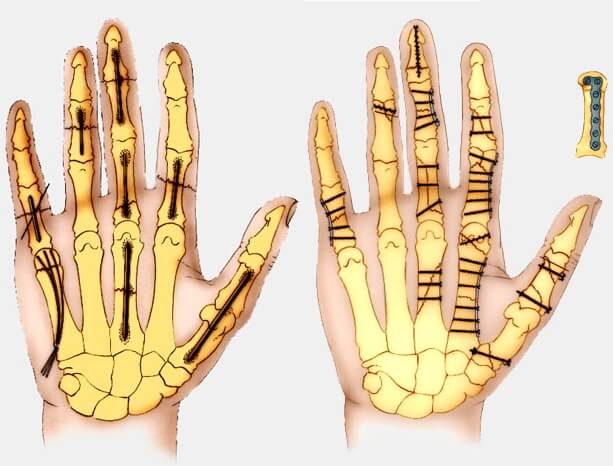 schéma fractures de la main