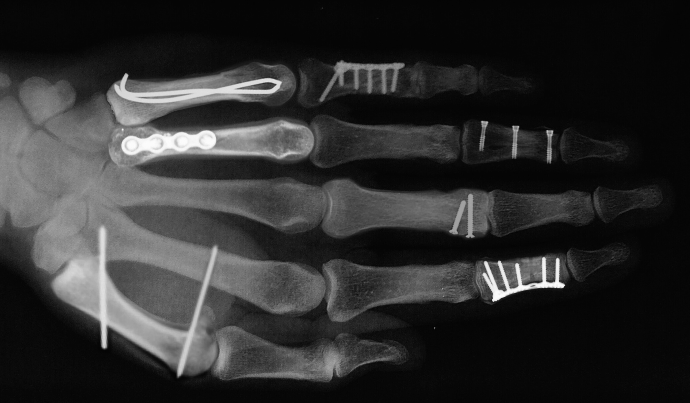 fractures de la main
