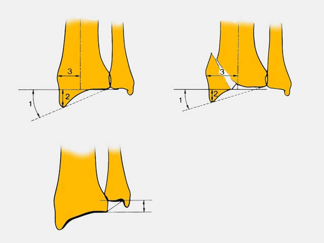 déplacement de la fracture