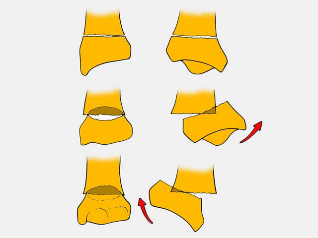 déplacement de la fracture