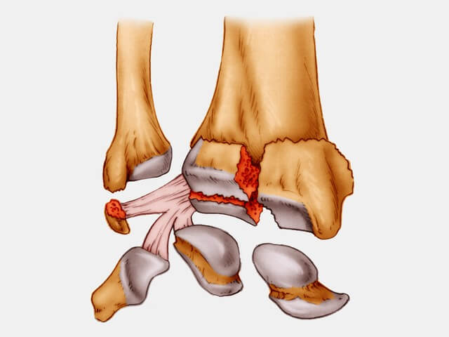 fracture articulaire du poignet