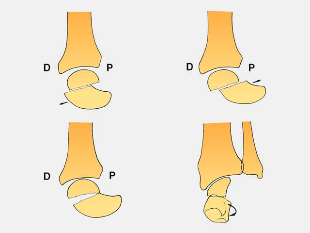 déplacement de la fracture