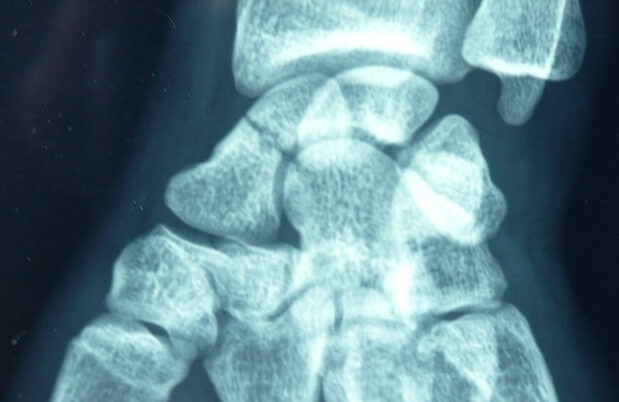 Fracture du scaphoïde