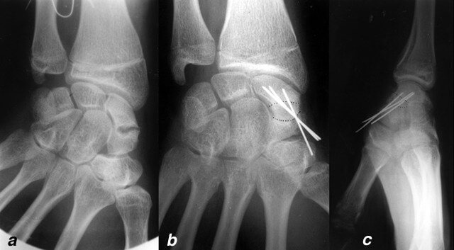 résultat radiographique